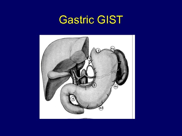 Gastric GIST 