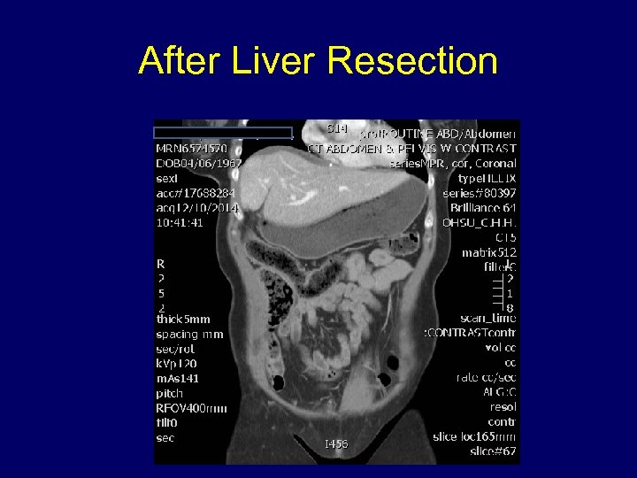 After Liver Resection 