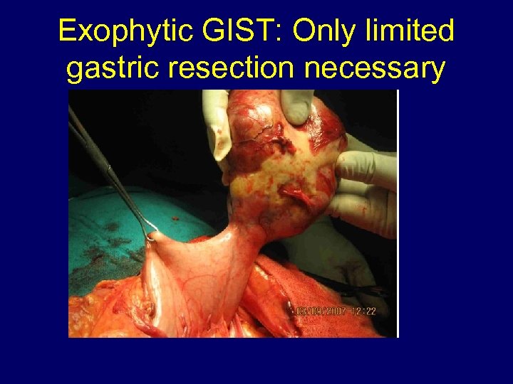 Exophytic GIST: Only limited gastric resection necessary 