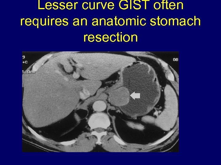 Lesser curve GIST often requires an anatomic stomach resection 