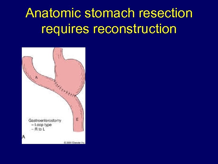 Anatomic stomach resection requires reconstruction 