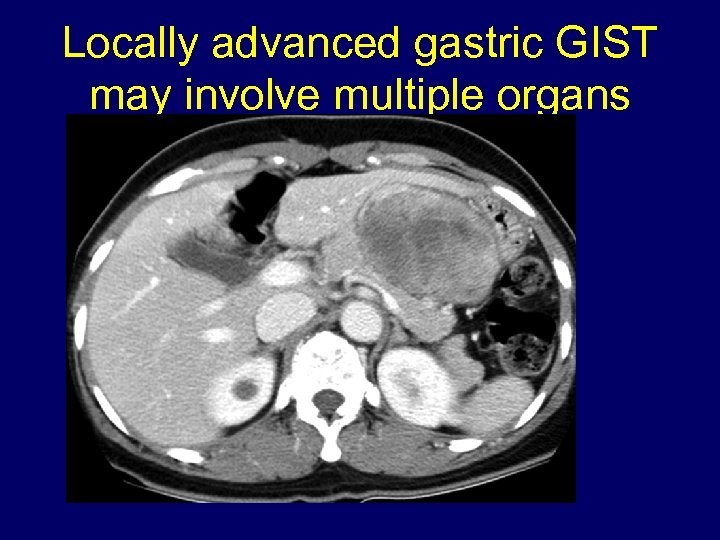 Locally advanced gastric GIST may involve multiple organs 