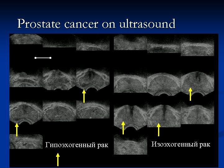 Prostate cancer on ultrasound Гипоэхогенный рак Изоэхогенный рак 
