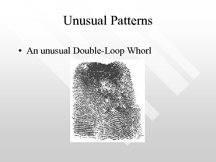 Unusual Patterns • An unusual Double-Loop Whorl 