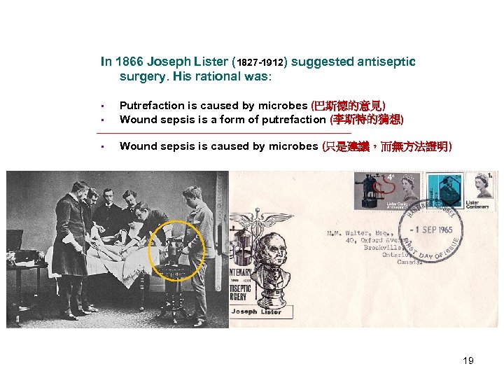 In 1866 Joseph Lister (1827 -1912) suggested antiseptic surgery. His rational was: • •