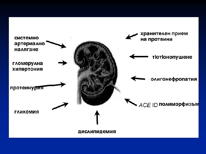 Diabetna Nefropatiya Doc D R Mihail Boyanov Dmn Klinika