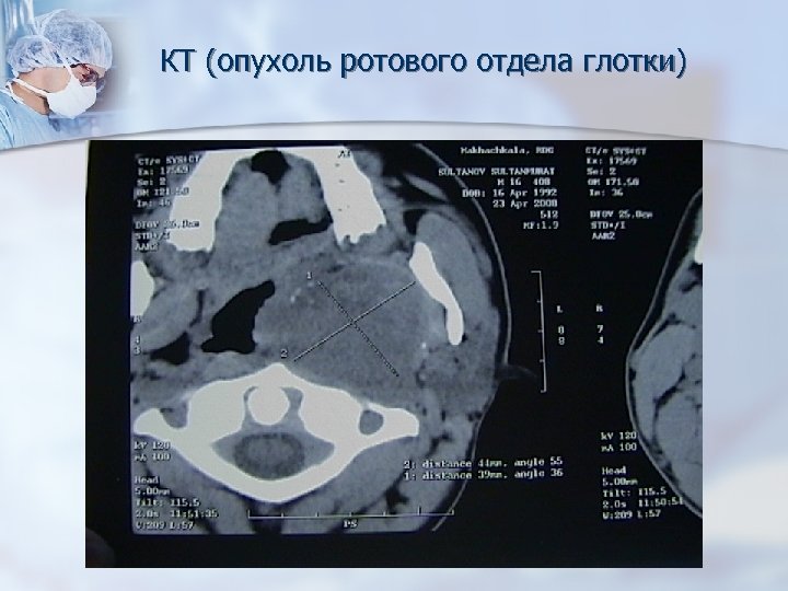 КТ (опухоль ротового отдела глотки) 