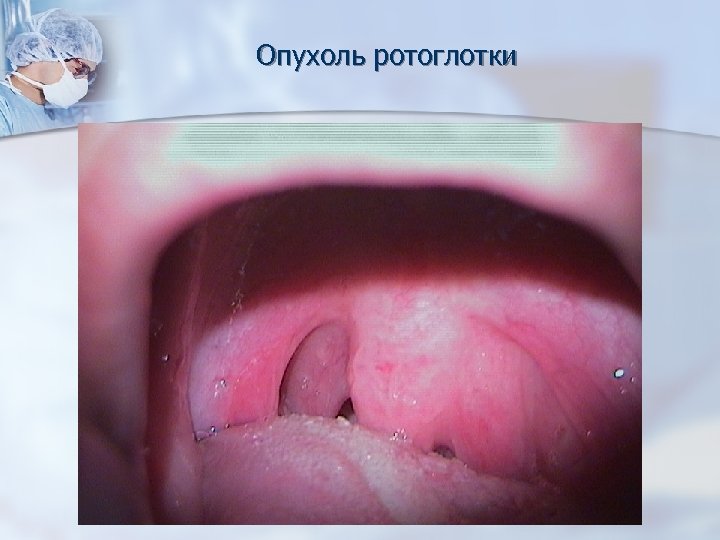 Опухоль ротоглотки 