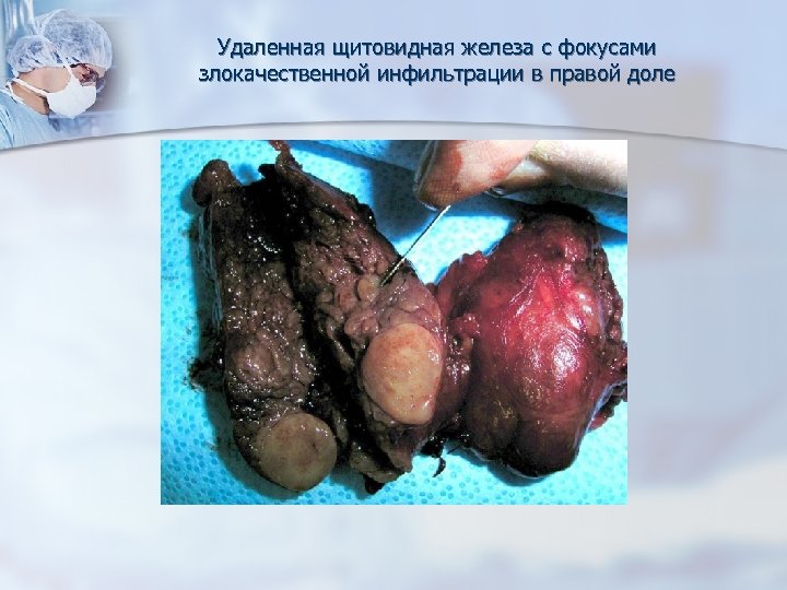 Удаленная щитовидная железа с фокусами злокачественной инфильтрации в правой доле 