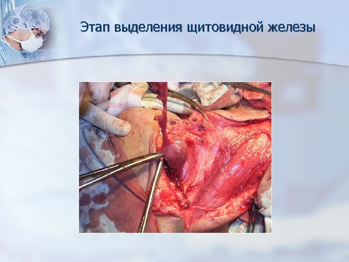 Этап выделения щитовидной железы 