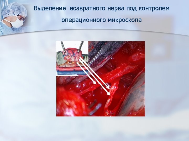 Выделение возвратного нерва под контролем операционного микроскопа 