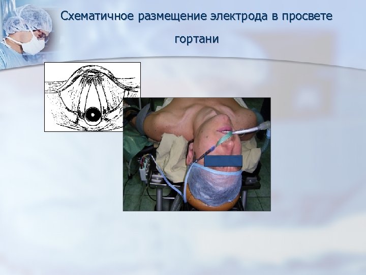Схематичное размещение электрода в просвете гортани 