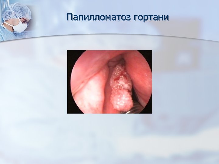 Папилломатоз гортани 