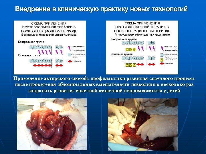 Внедрение в клиническую практику новых технологий Применение авторского способа профилактики развития спаечного процесса после