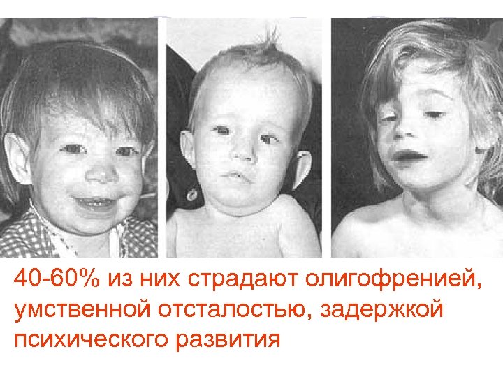40 -60% из них страдают олигофренией, умственной отсталостью, задержкой психического развития 