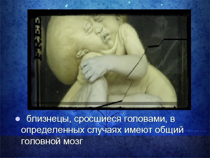 l близнецы, сросшиеся головами, в определенных случаях имеют общий головной мозг. 