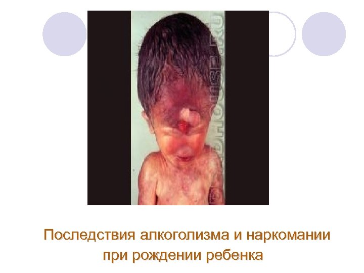 Последствия алкоголизма и наркомании при рождении ребенка 
