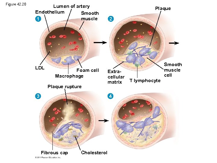 Figure 42. 20 Lumen of artery Endothelium Smooth muscle 1 LDL Foam cell Macrophage