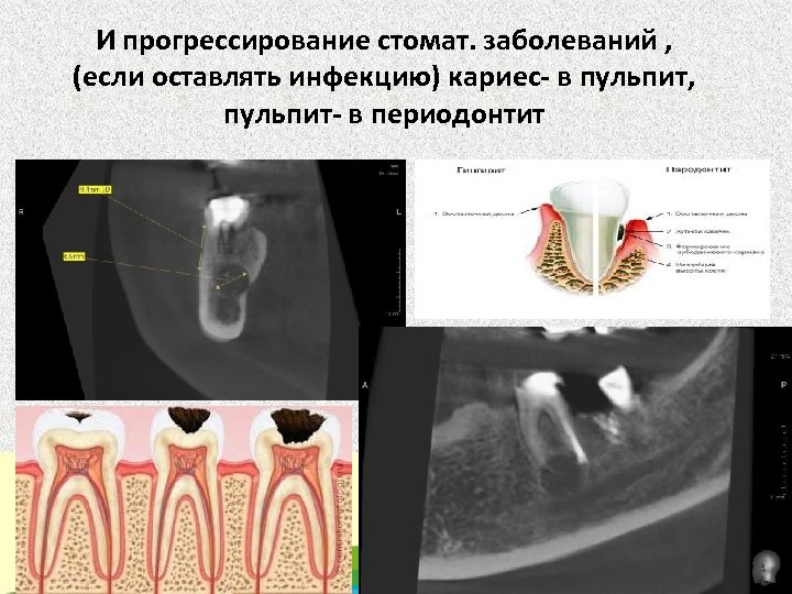 И прогрессирование стомат. заболеваний , (если оставлять инфекцию) кариес- в пульпит, пульпит- в периодонтит