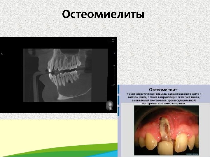 Остеомиелиты 