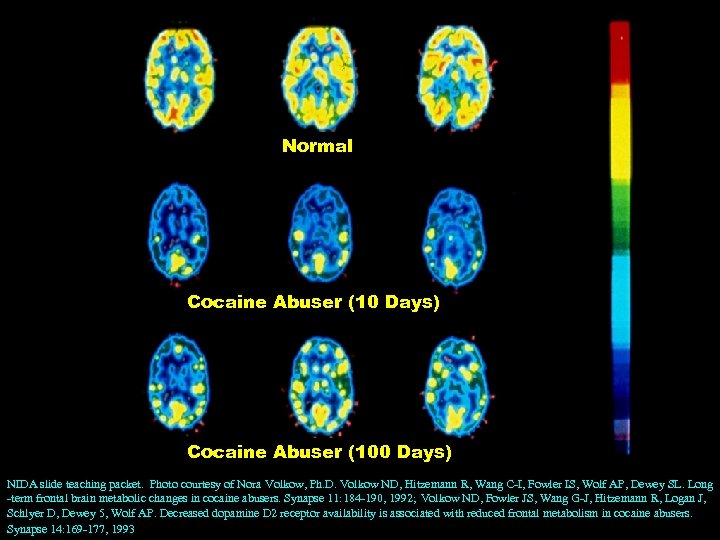 Normal Cocaine Abuser (10 Days) Cocaine Abuser (100 Days) NIDA slide teaching packet. Photo