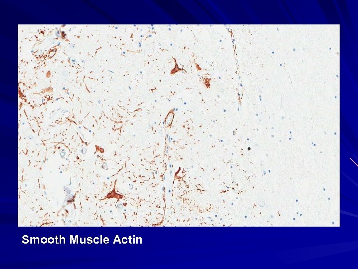 Smooth Muscle Actin 