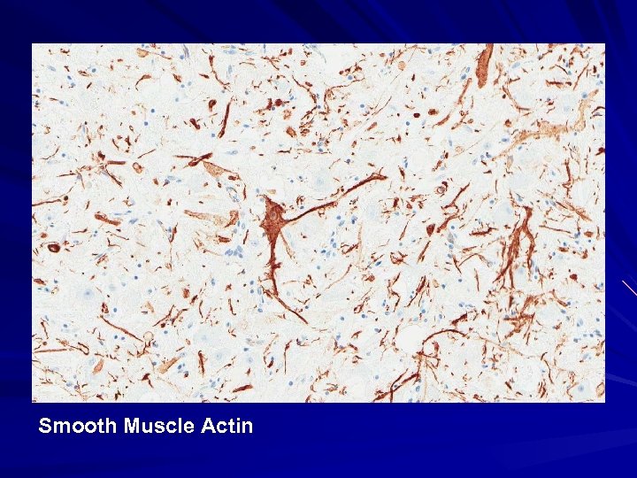 Smooth Muscle Actin 
