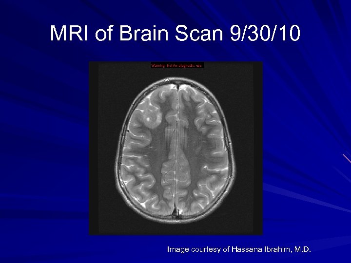 MRI of Brain Scan 9/30/10 Image courtesy of Hassana Ibrahim, M. D. 