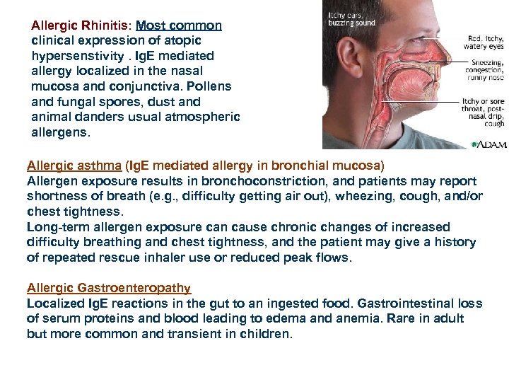 Allergic Rhinitis: Most common clinical expression of atopic hypersenstivity. Ig. E mediated allergy localized