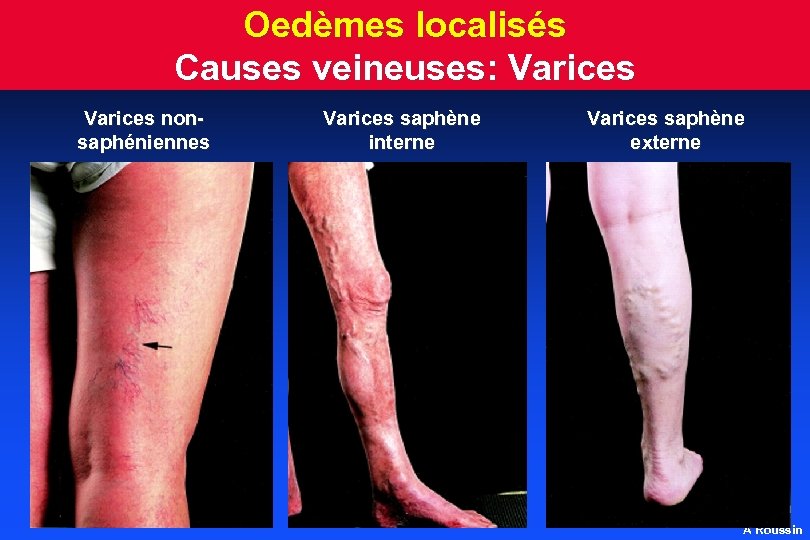 Oedèmes localisés Causes veineuses: Varices nonsaphéniennes Varices saphène interne Varices saphène externe A Roussin