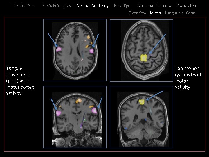 Introduction Basic Principles Normal Anatomy Paradigms Unusual Patterns Discussion Overview Motor Language Other I