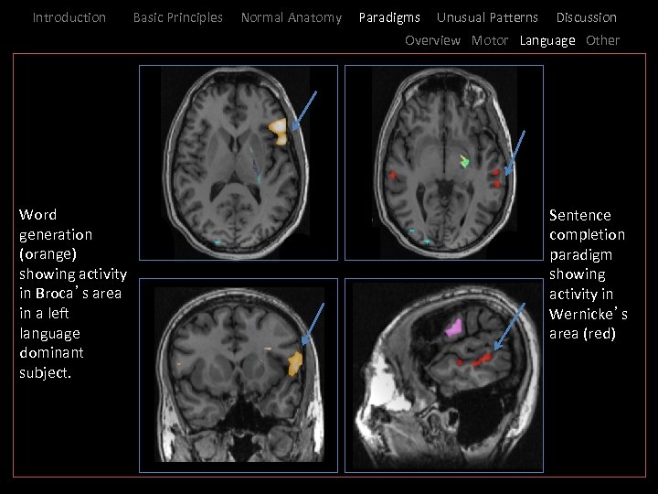 Introduction Basic Principles Normal Anatomy Paradigms Unusual Patterns Discussion Overview Motor Language Other I