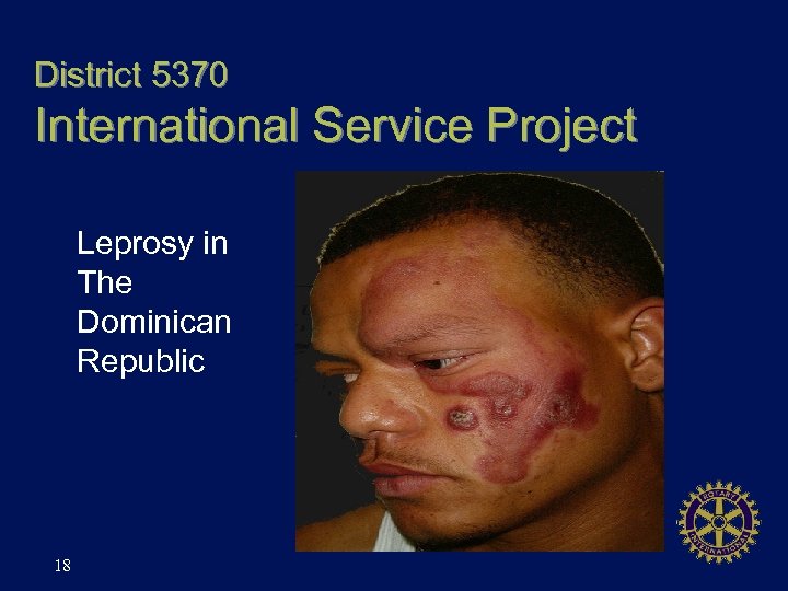 District 5370 International Service Project Leprosy in The Dominican Republic 18 