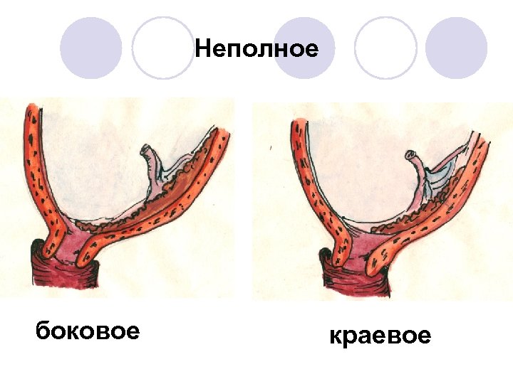 Краевое предлежание плаценты. Формирование Нижнего сегмента матки. Плацента в Нижнем сегменте матки. Область внутреннего зева воронкообразная. Нижний сегмент плаценты около среза головки.