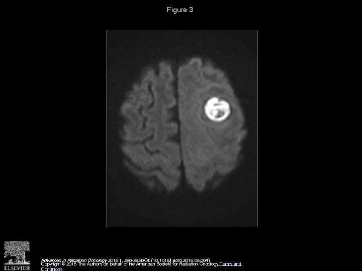 Figure 3 Advances in Radiation Oncology 2016 1, 290 -293 DOI: (10. 1016/j. adro.