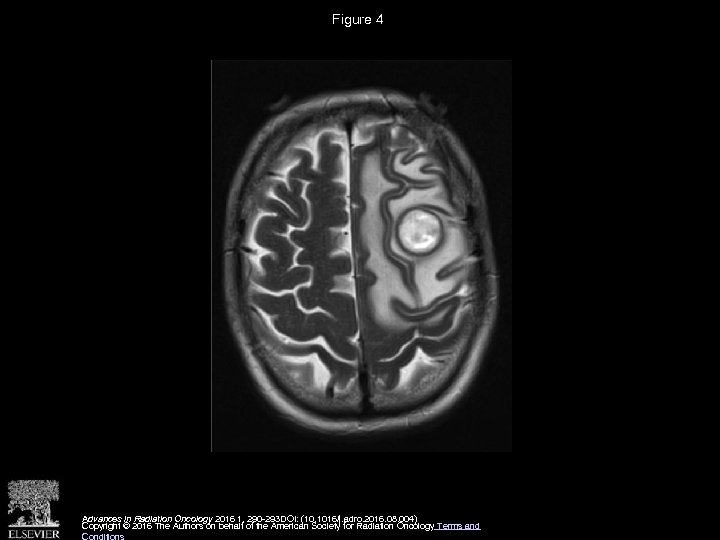 Figure 4 Advances in Radiation Oncology 2016 1, 290 -293 DOI: (10. 1016/j. adro.