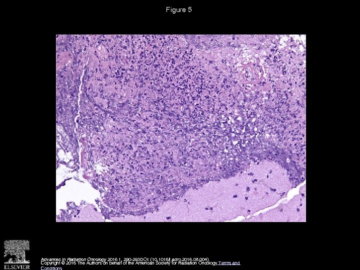 Figure 5 Advances in Radiation Oncology 2016 1, 290 -293 DOI: (10. 1016/j. adro.