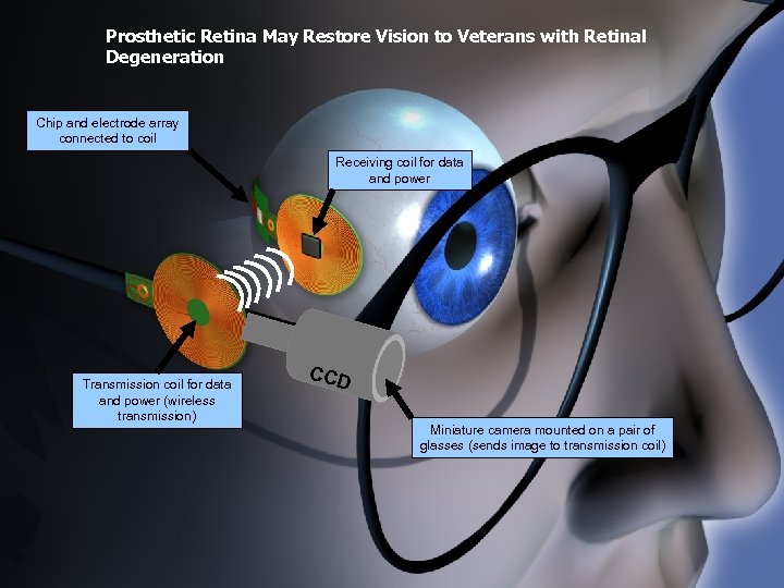Prosthetic Retina May Restore Vision to Veterans with Retinal Degeneration Chip and electrode array