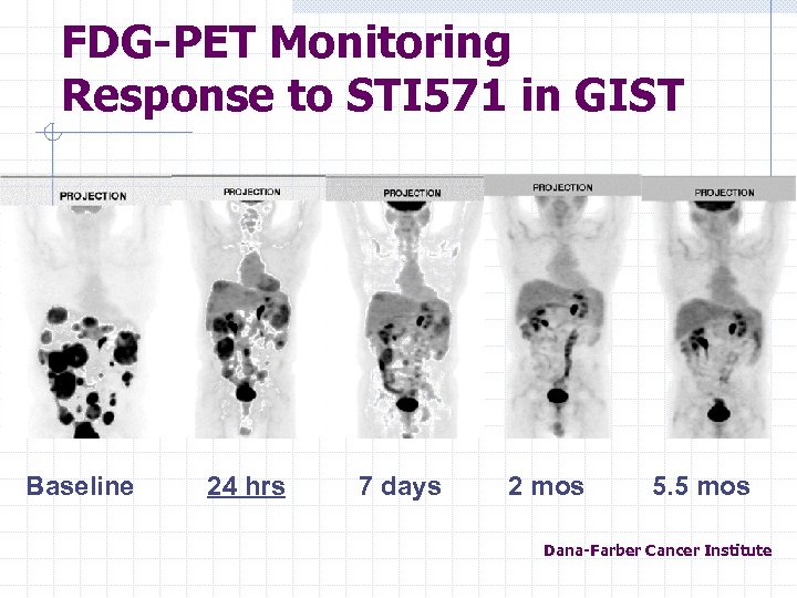 FDG-PET Monitoring Response to STI 571 in GIST Baseline 24 hrs 7 days 2