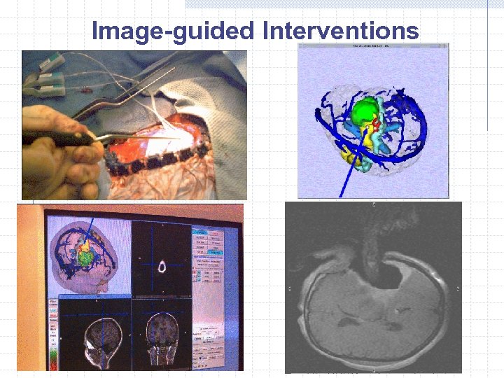 Image-guided Interventions 