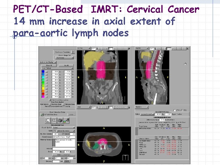 PET/CT-Based IMRT: Cervical Cancer 14 mm increase in axial extent of para-aortic lymph nodes