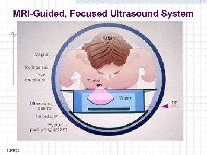 MRI-Guided, Focused Ultrasound System KHH 99 