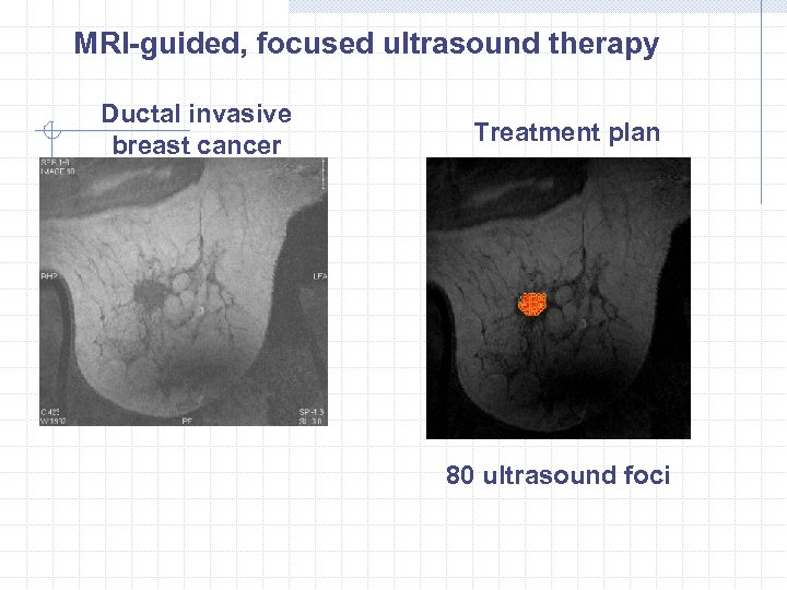 MRI-guided, focused ultrasound therapy Ductal invasive breast cancer Treatment plan 80 ultrasound foci 