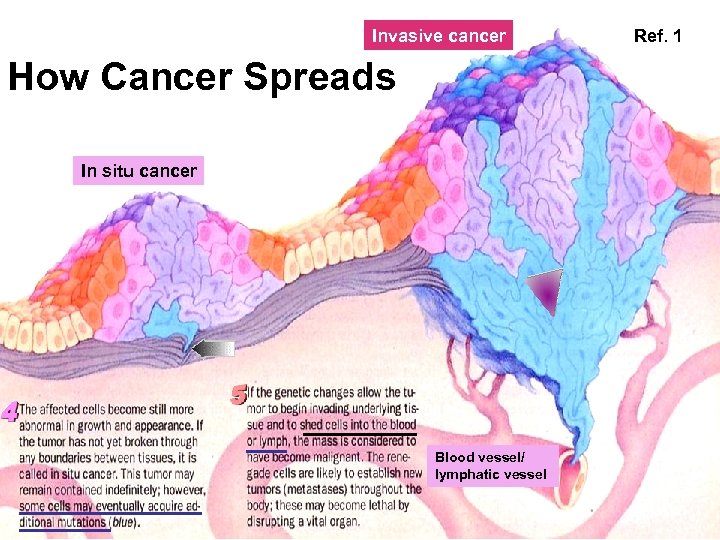 Invasive cancer How Cancer Spreads In situ cancer Blood vessel/ lymphatic vessel Ref. 1