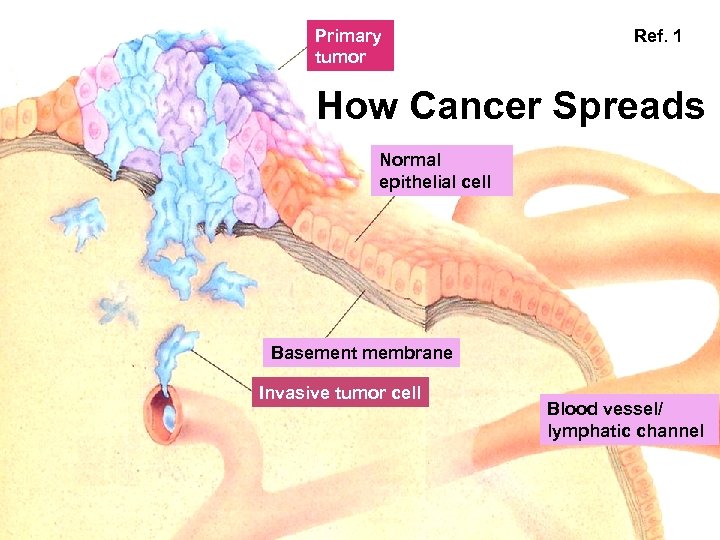 Primary tumor Ref. 1 How Cancer Spreads Normal epithelial cell Basement membrane Invasive tumor