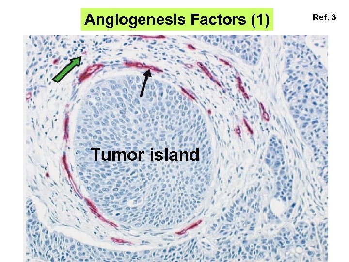 Angiogenesis Factors (1) Tumor island Ref. 3 