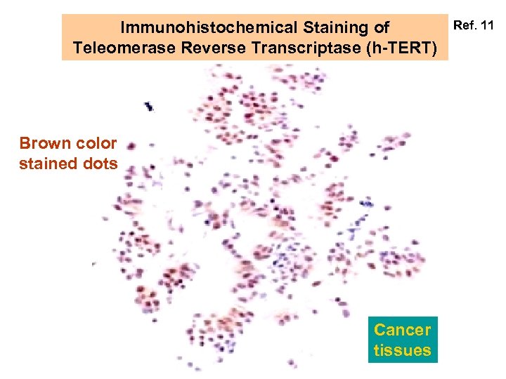 Immunohistochemical Staining of Teleomerase Reverse Transcriptase (h-TERT) Brown color stained dots Cancer tissues Ref.