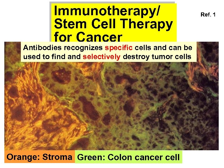 Immunotherapy/ Stem Cell Therapy for Cancer Antibodies recognizes specific cells and can be used