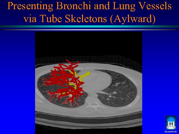 Presenting Bronchi and Lung Vessels via Tube Skeletons (Aylward) MIDAG@UNC 