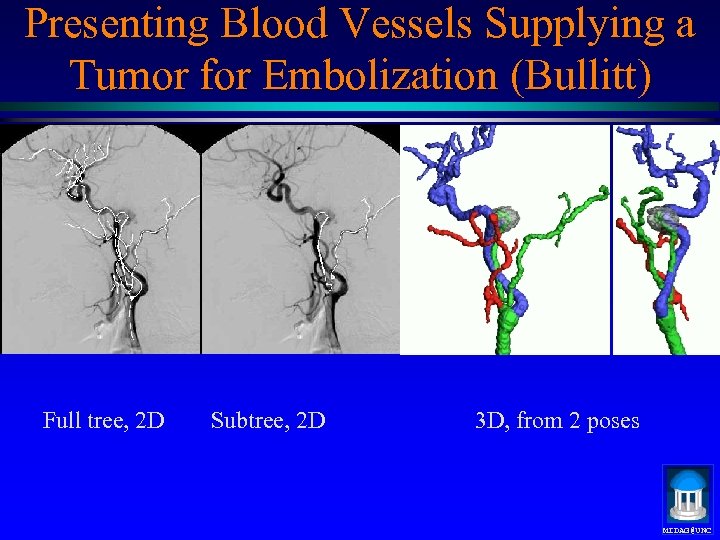 Presenting Blood Vessels Supplying a Tumor for Embolization (Bullitt) Full tree, 2 D Subtree,